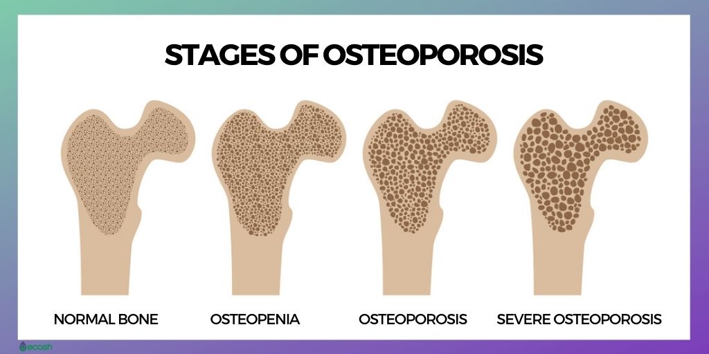 Stages of Osteoporosis