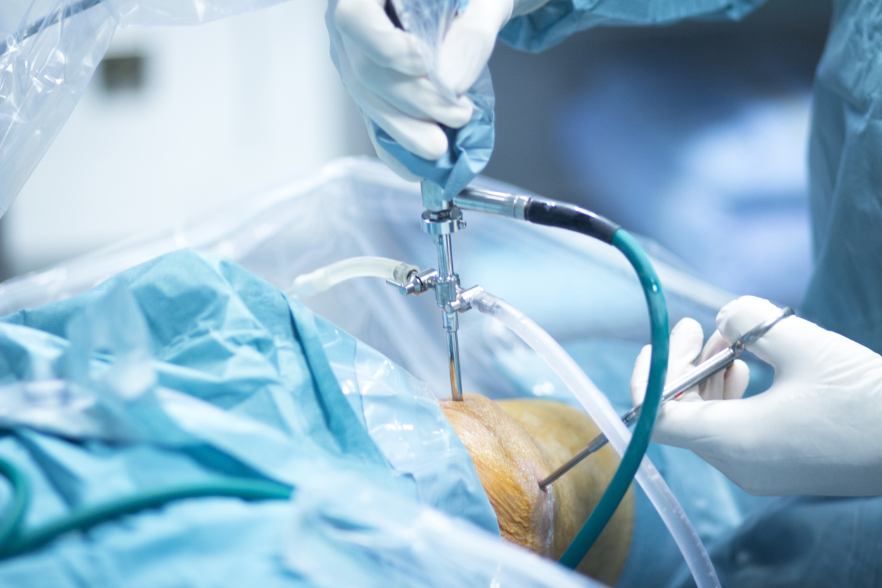 Know the Benefits of arthroscopic surgery