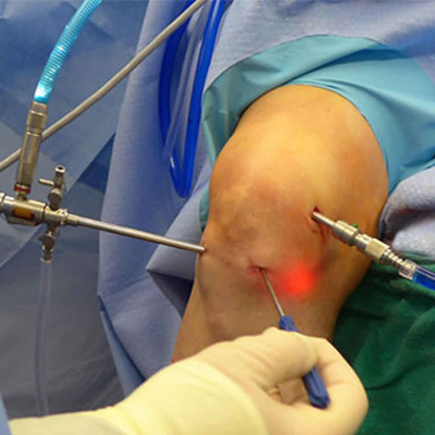 Arthroscopy