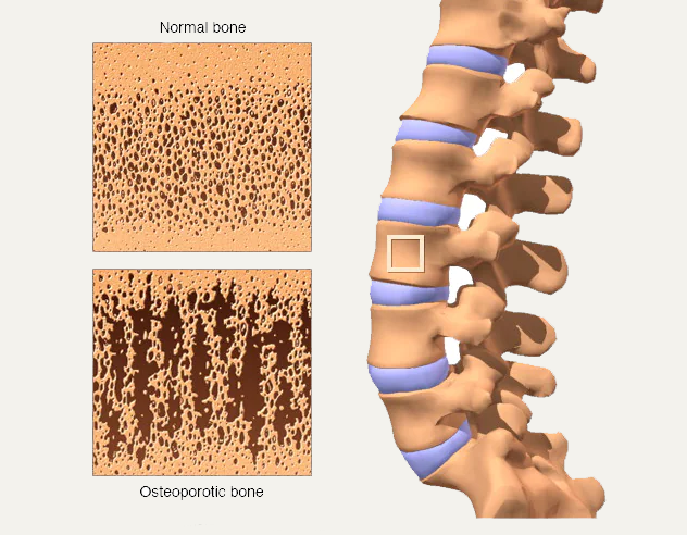 OSTEOPOROSIS